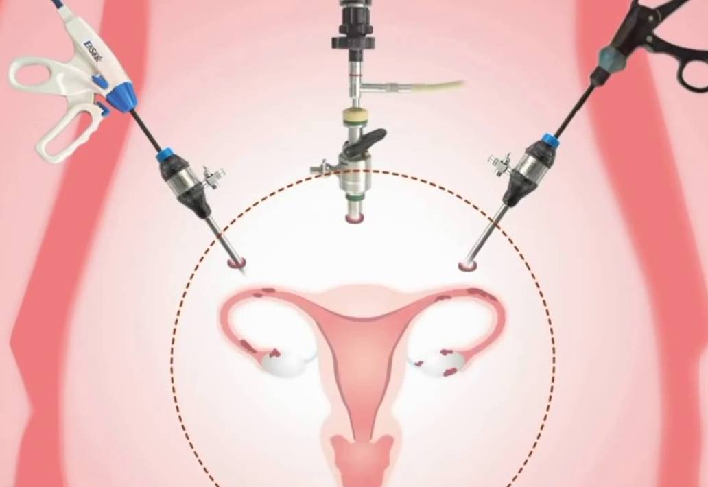 Laparoscopic removal of uterine fibroids 