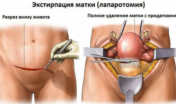 Laparoscopic extirpation of the uterus