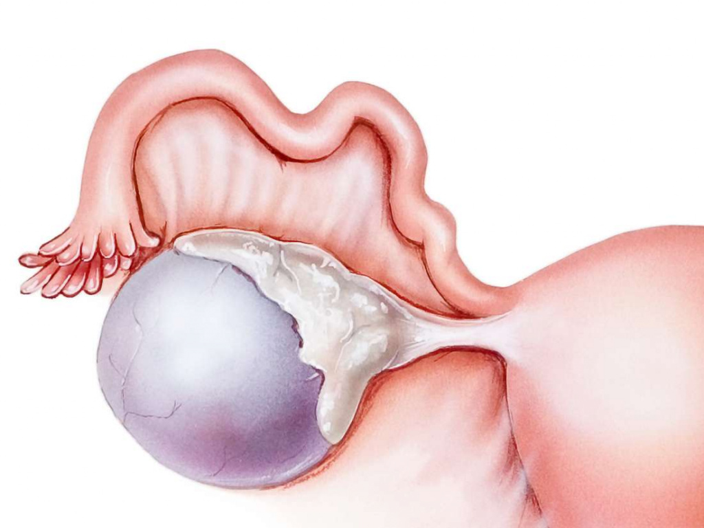 Laparoscopic removal of ovarian cysts. Diagnostics. Treatment