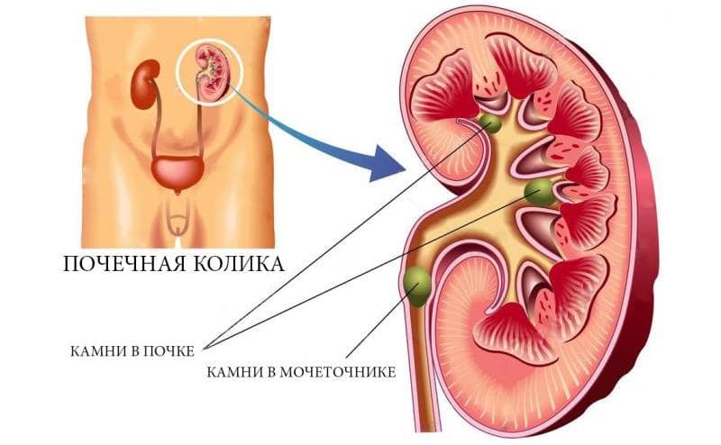 Treatment of renal colic