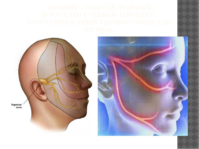  Treatment of trigeminal neuralgia 