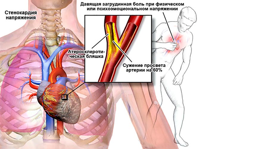 Treatment of angina pectoris