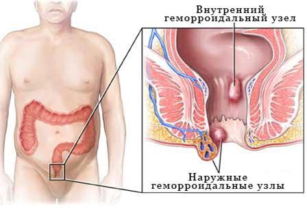 Modern methods of treatment of hemorrhoids