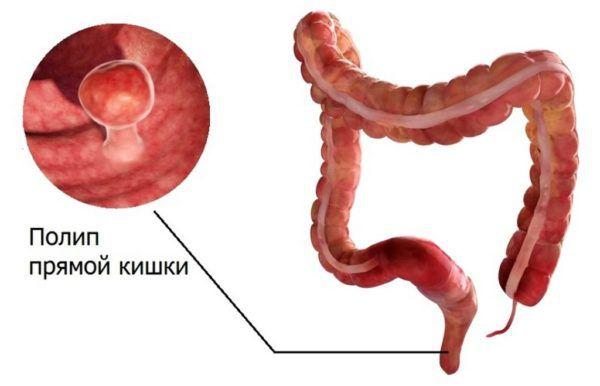 Treatment of a benign neoplasm of the rectum and perianal region 
