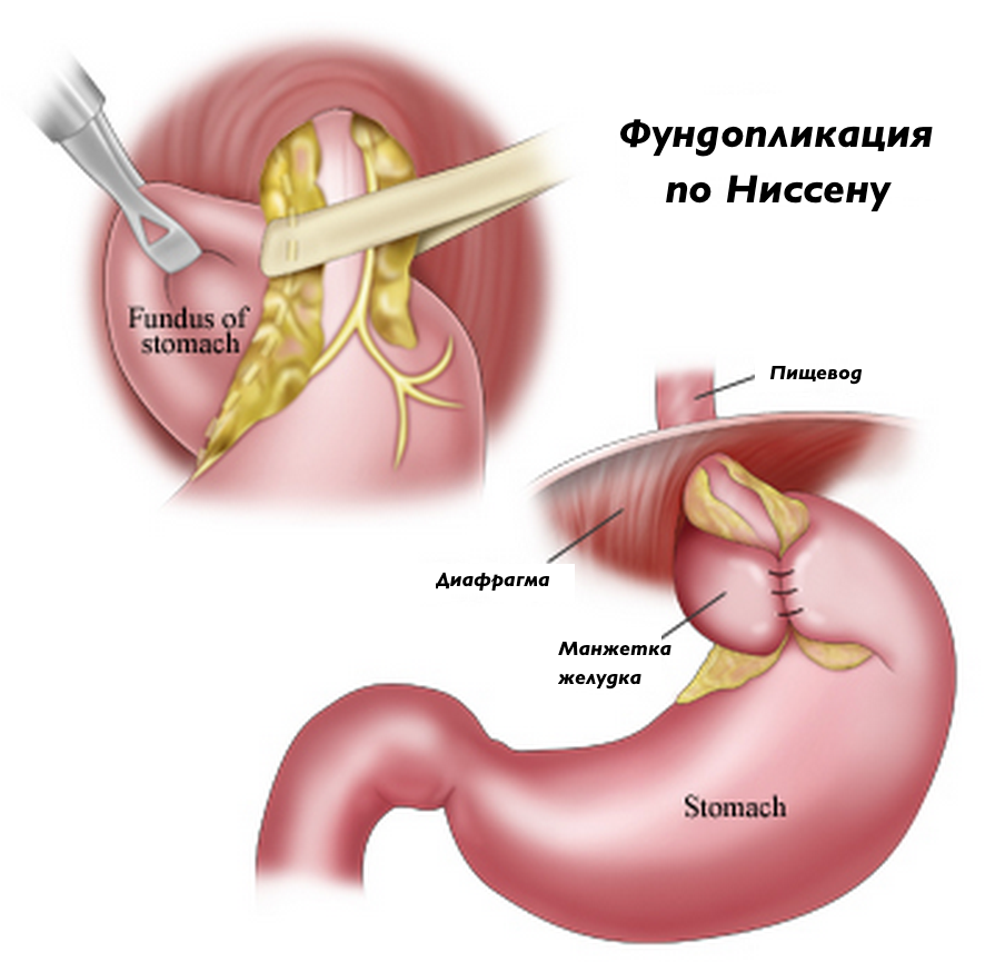 Treatment of laparoscopic fundoplication for hiatal hernia