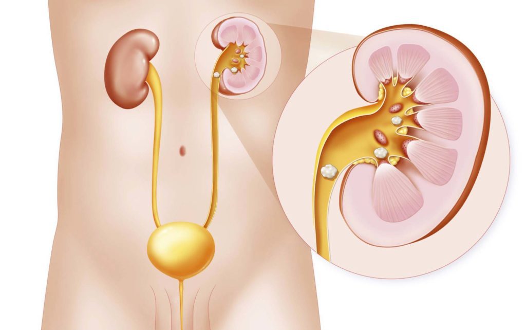 Treatment of stones in the ureter