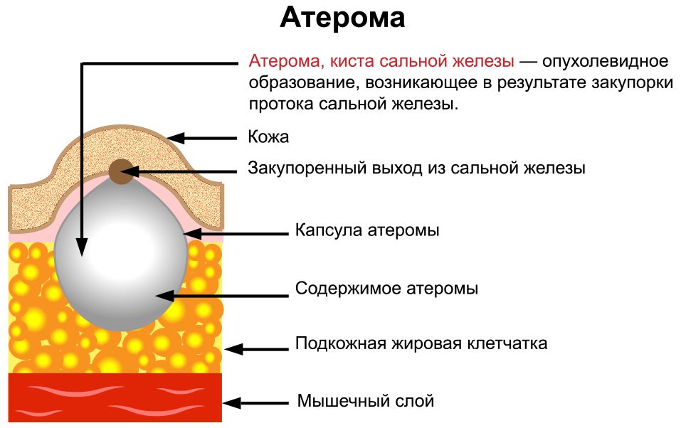 Атерома. Лечение в Ташкенте 