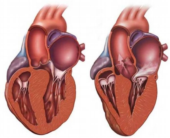 Дифференциальная диагностика кардиомиопатии 