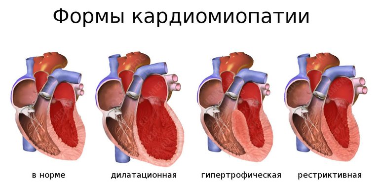 Types of cardiomyopathy. Treatment of cardiomyopathy 