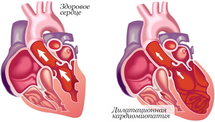 Cовременные методы лечение кардиомиопатии 