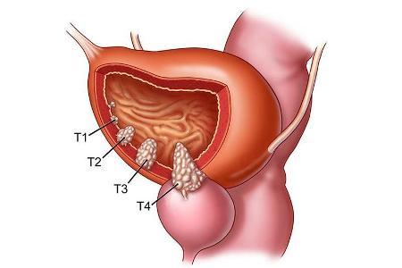 Symptoms and treatment of urethral polyp 