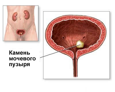 Bladder stones - causes, symptoms and diagnosis 