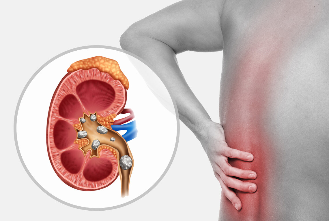 Kidney stones - causes, symptoms and diagnosis