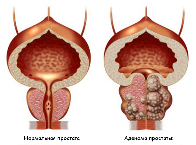Prostata adenomasini davolash