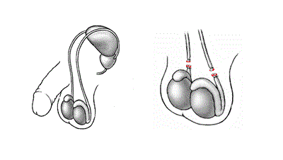 Ligation of the spermatic cord (vasectomy) 