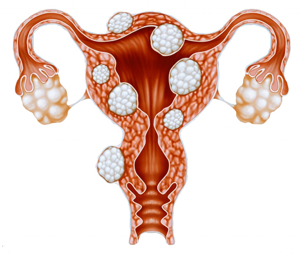 Symptoms Causes. Treatment . Incipient uterine fibroids 