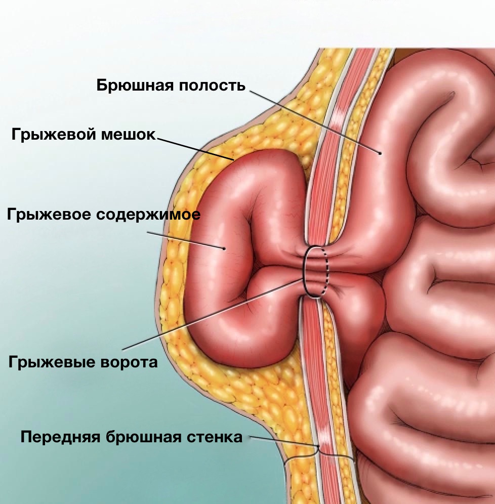Umbilical hernia. Diagnostics. Treatment.