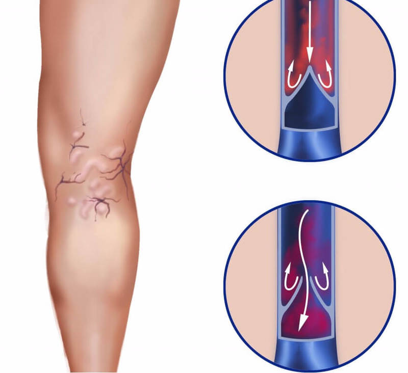 Diagnostics and treatment of varicose vessels of the lower extremities