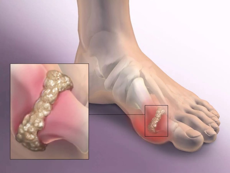 Diagnostics and treatment of gout 
