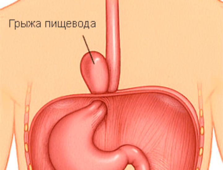 Diagnostics and treatment of hernia of the esophagus
