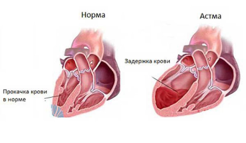 Дифференциальная диагностика сердечной астмы и бронхиальной астмы
