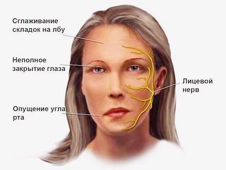 Treatment of neuropathy of the facial nerve