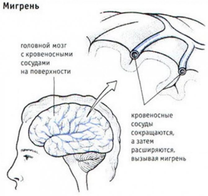 Migraine treatment 