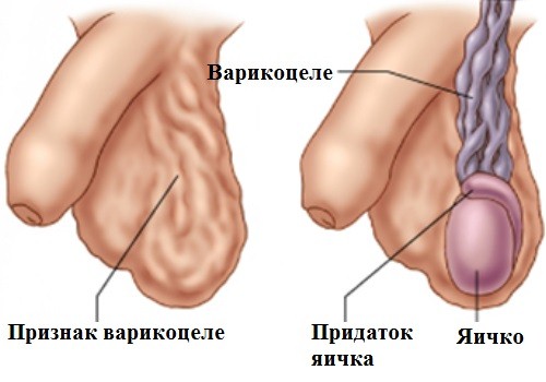 Варикоцеле  диагностика и лечение в Ташкенте