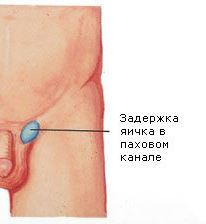 Testicular hypoplasia. Treatment in Tashkent