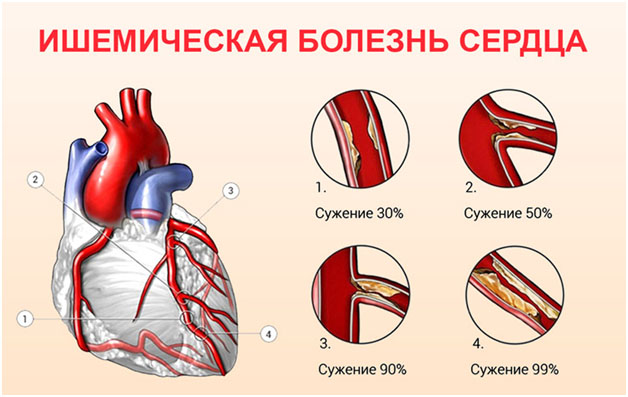 Modern methods of treatment of coronary heart disease