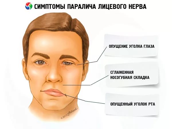 High-quality and modern Treatment of Bell's Palsy