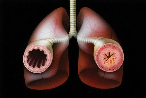  Дифференциальная диагностика хронического обструктивного бронхита и бронхиальной астмы 