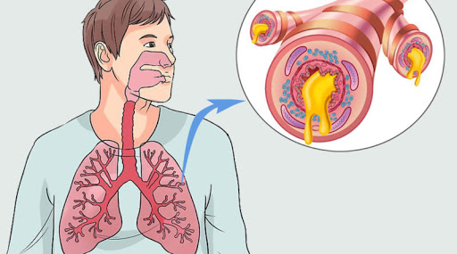 Methods of treatment of chronic obstructive bronchitis