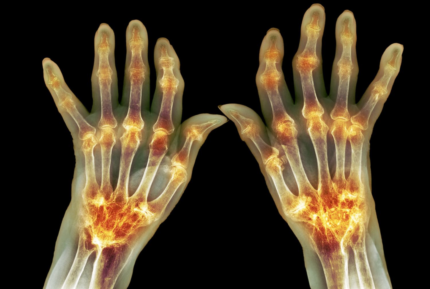 Methods of treatment of rheumatoid arthritis