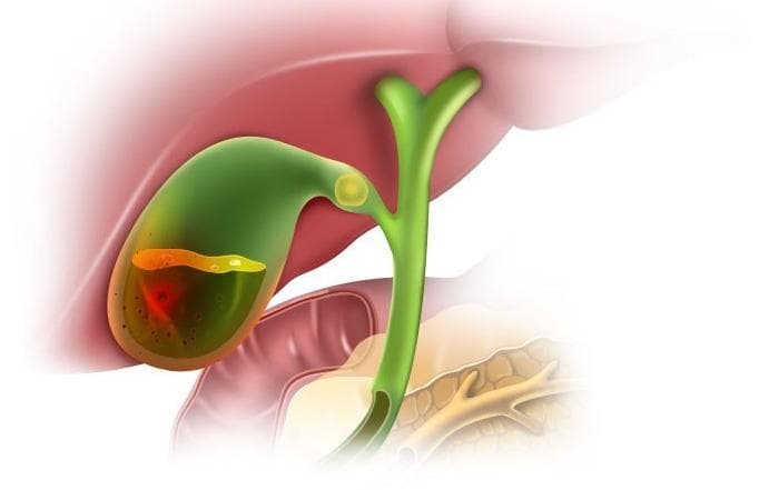Diagnosis and treatment of chronic cholecystitis