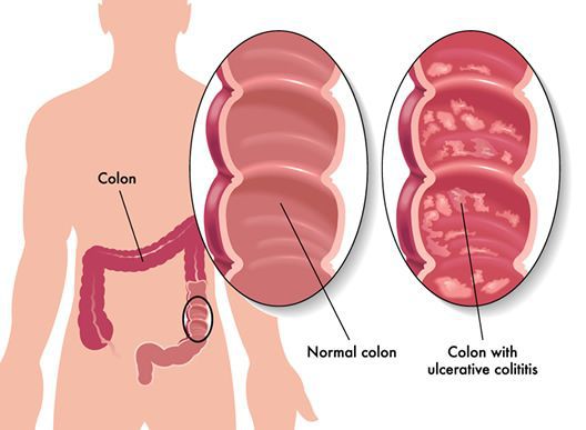 Treatment of ulcerative colitis 