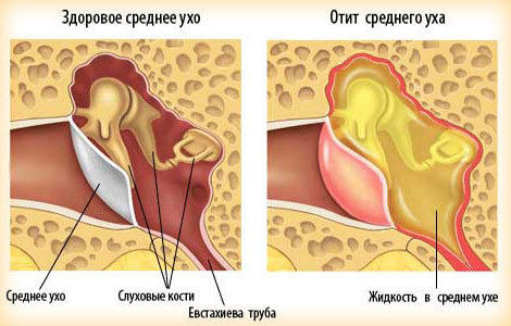 Treatment of otitis media - inflammation of the middle