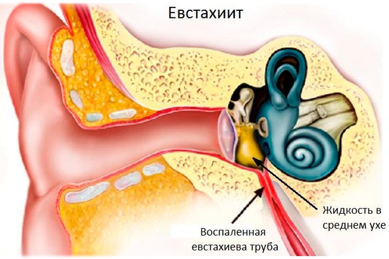 Eustachitis treatment