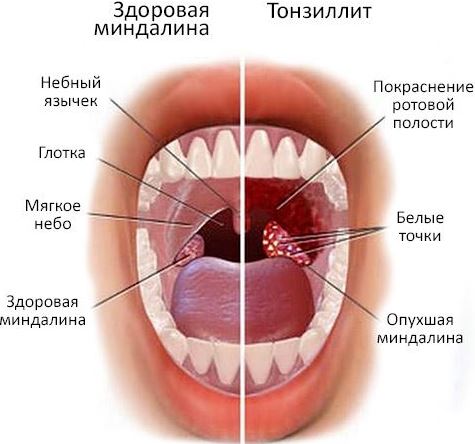 Treatment of chronic tonsillitis