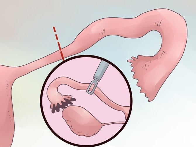 Treatment of obstruction of the fallopian tubes and microsurgical operations