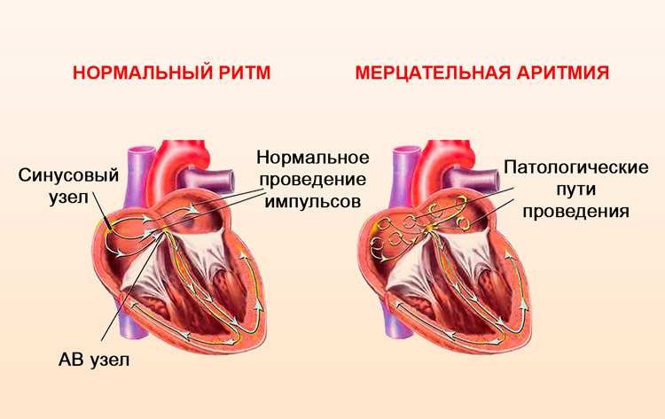Лечение сердечной аритмии