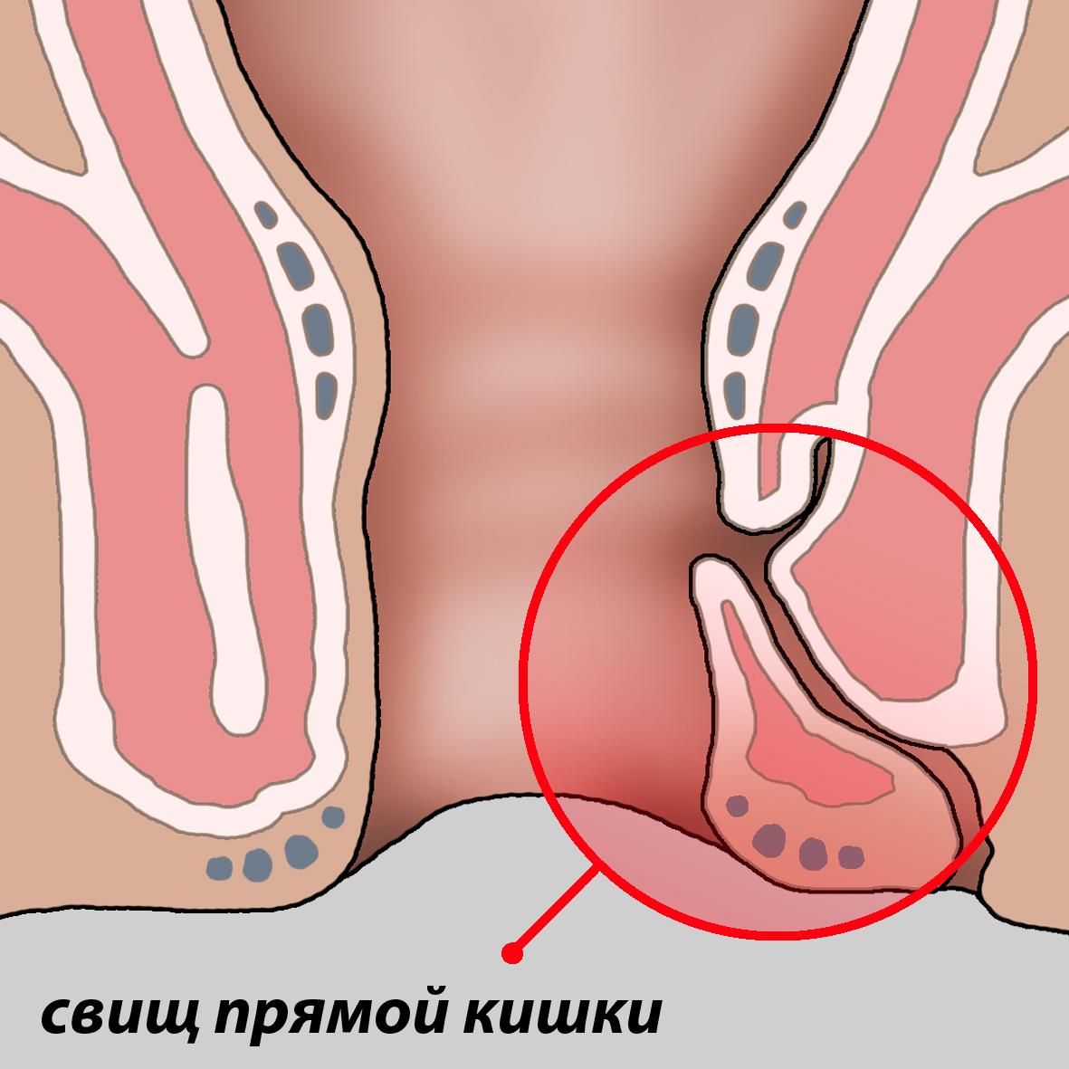 Effective methods of treatment of rectal fistula 