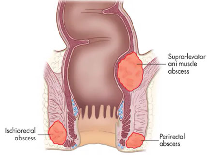 Treatment of cysts of the perianal region 