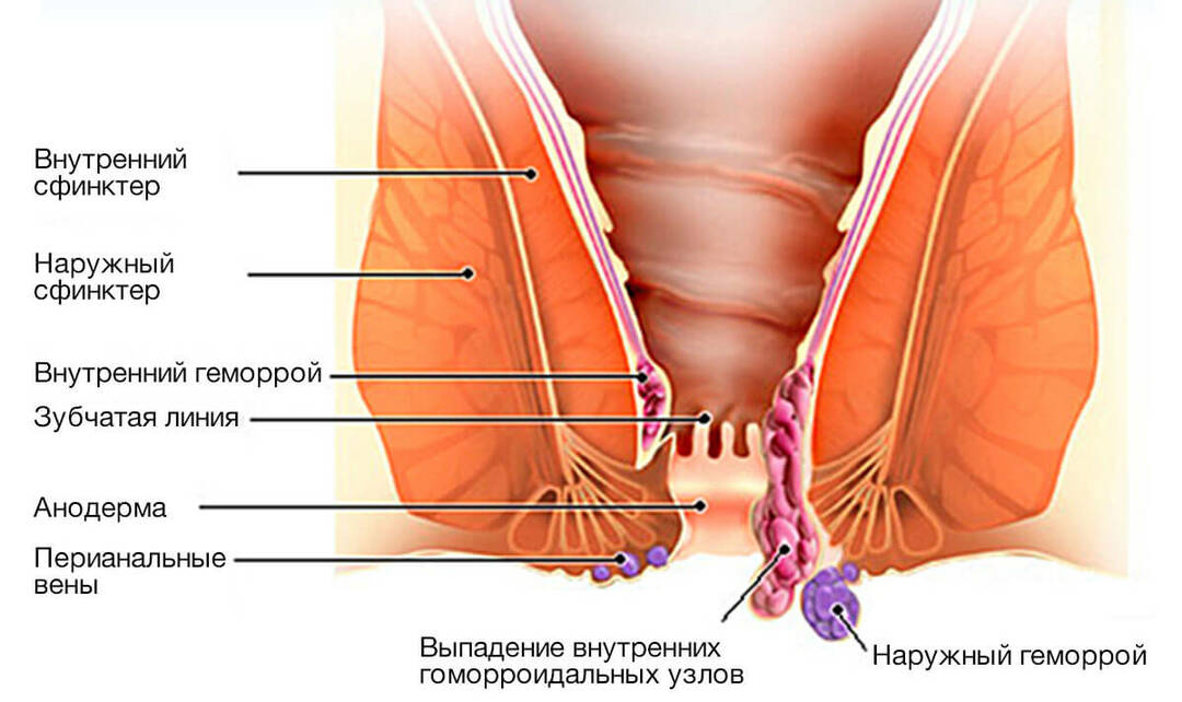 Treatment of sphincteritis in Tashkent 