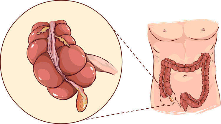 The process of treatment of acute appendicitis