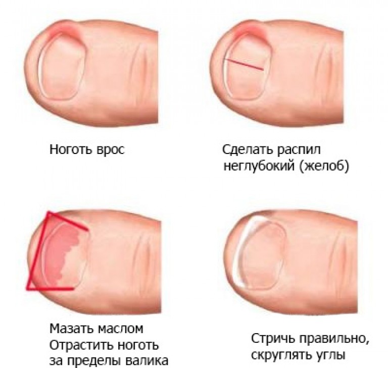 Лечение краевой резекции вросшего ногтя с пластикой и лазерной обработкой 