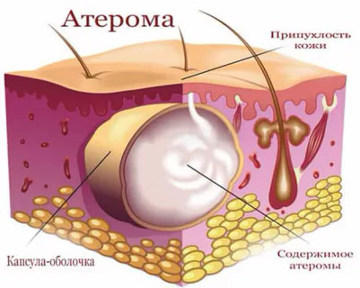 Laser removal of atheromas, lipomas, papillomas