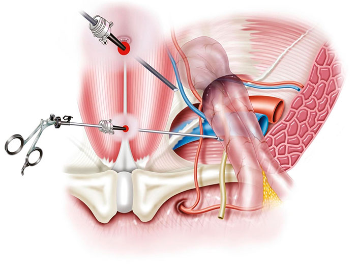 Treatment of hernias with alloplasty (postoperative hernias, hernias of the anterior abdominal wall, inguinal and femoral hernias) 