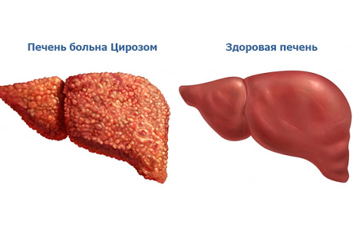 Treatment of liver cirrhosis