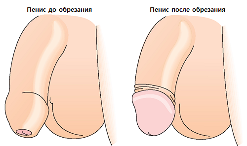 Circumcision of the foreskin